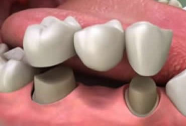 Understanding the Basics About Dental Crowns and Dental Bridges