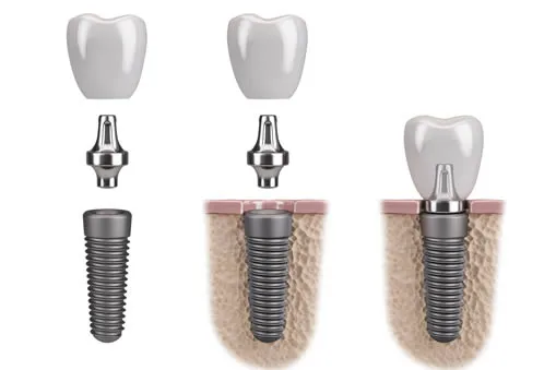 dental implant stages