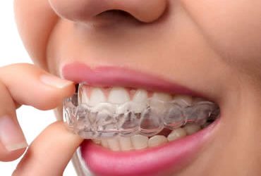 Should My Teen Choose Invisalign or Traditional Braces